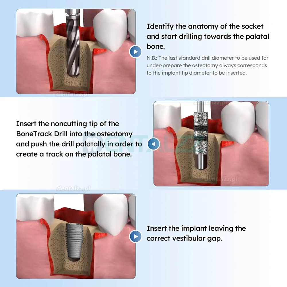 FG7604 Zestaw 4 Wierteł do Toru Kości Implantologicznych do Pozycjonowania i Korekcji Szyjki